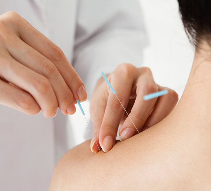 akupuntur-anxiety