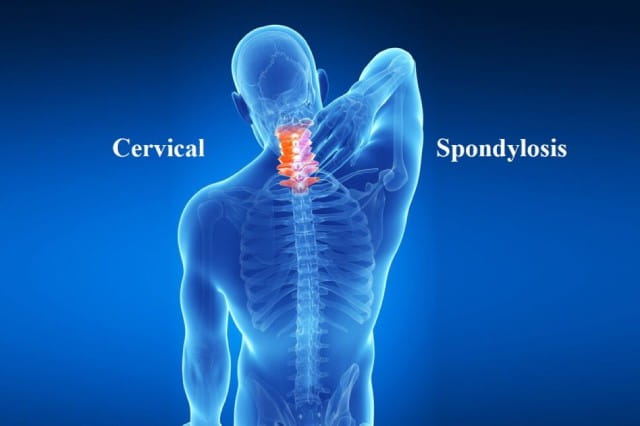 kebaikan-acupuncture-cervical-spondylosis