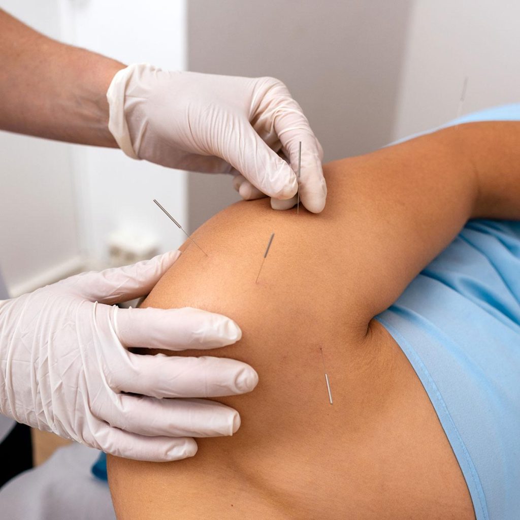 akupuntur-sakit-badan