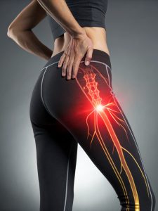piriformis-syndrome-acupuncture