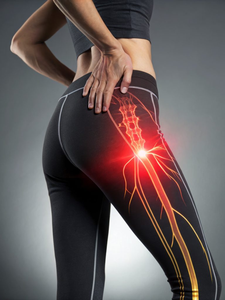 piriformis-syndrome-acupuncture