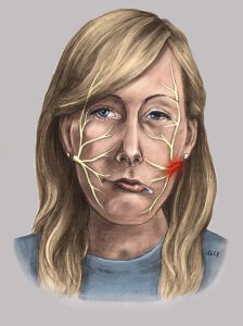 bell's palsy treatment