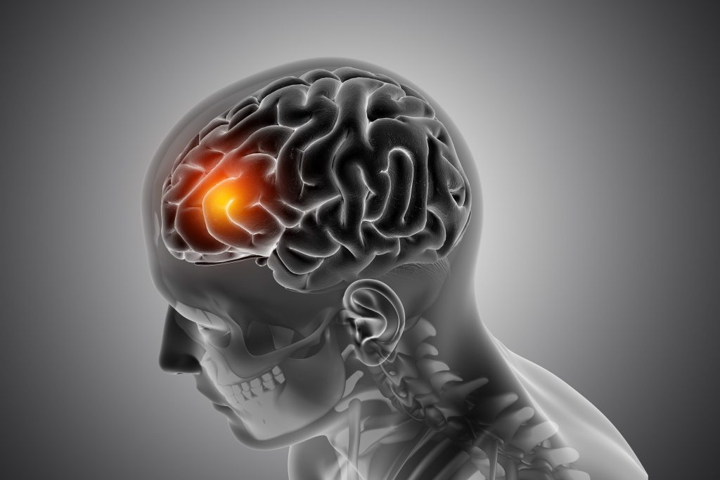 minor-stroke-symptoms-and-acupuncture