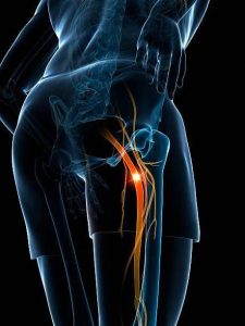 STIFF NERVE
