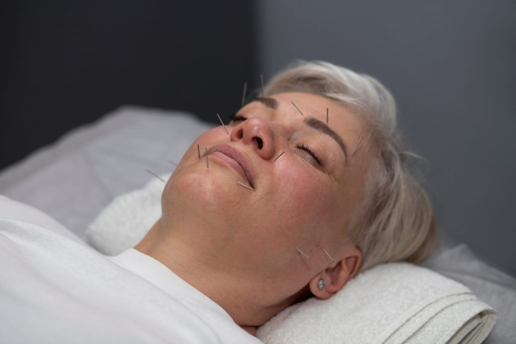 acupuncture-insomnia